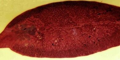 parassita trematode come rimuovere dal corpo
