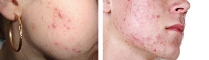 eruzione cutanea come sintomo della presenza di vermi sottocutanei